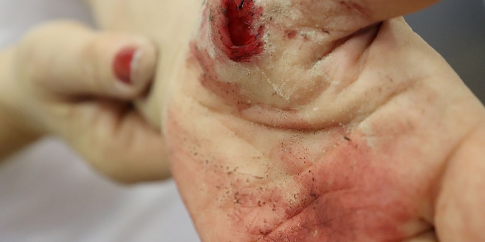 Prikaz stanja ogreban dlan koji krvari